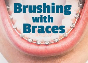 Des Moines dentist, Dr. Chad Johnson of Veranda Dentistry informs patients about the best tools and tricks to use when performing oral hygiene routines with braces.